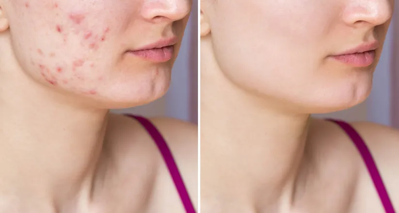 img adult acne clinical trial